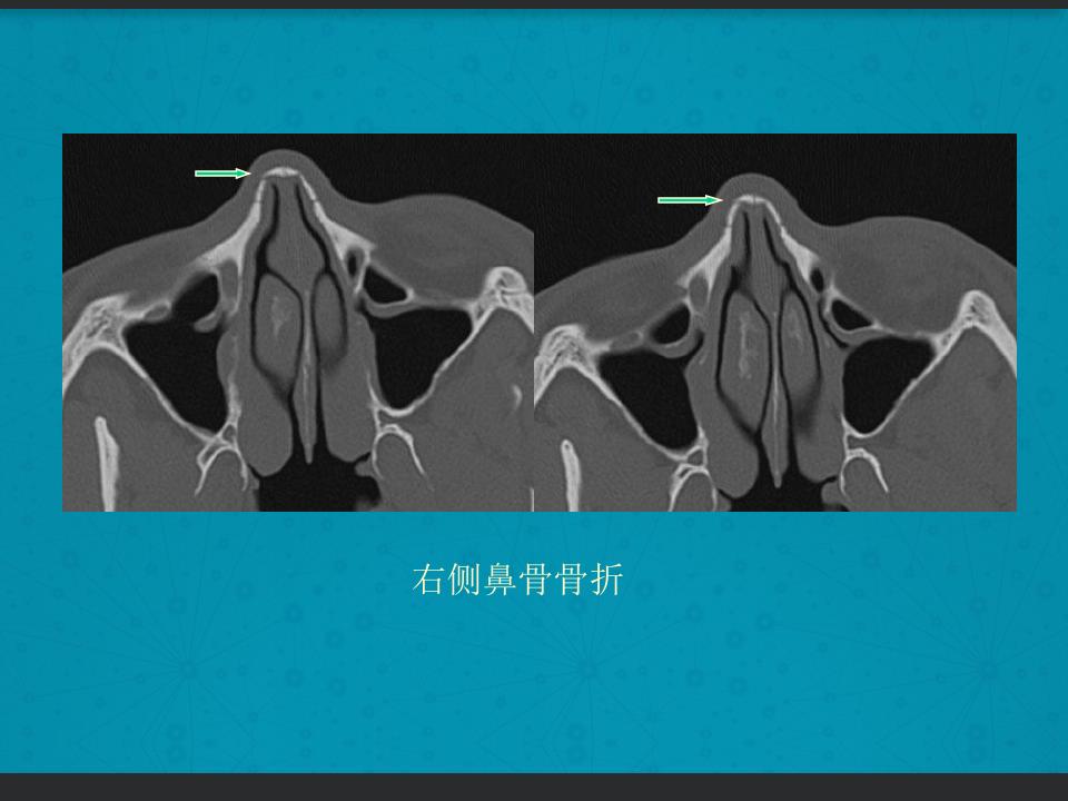 鼻骨骨折复位全过程,诊断证明鼻骨骨折问号是什么意思