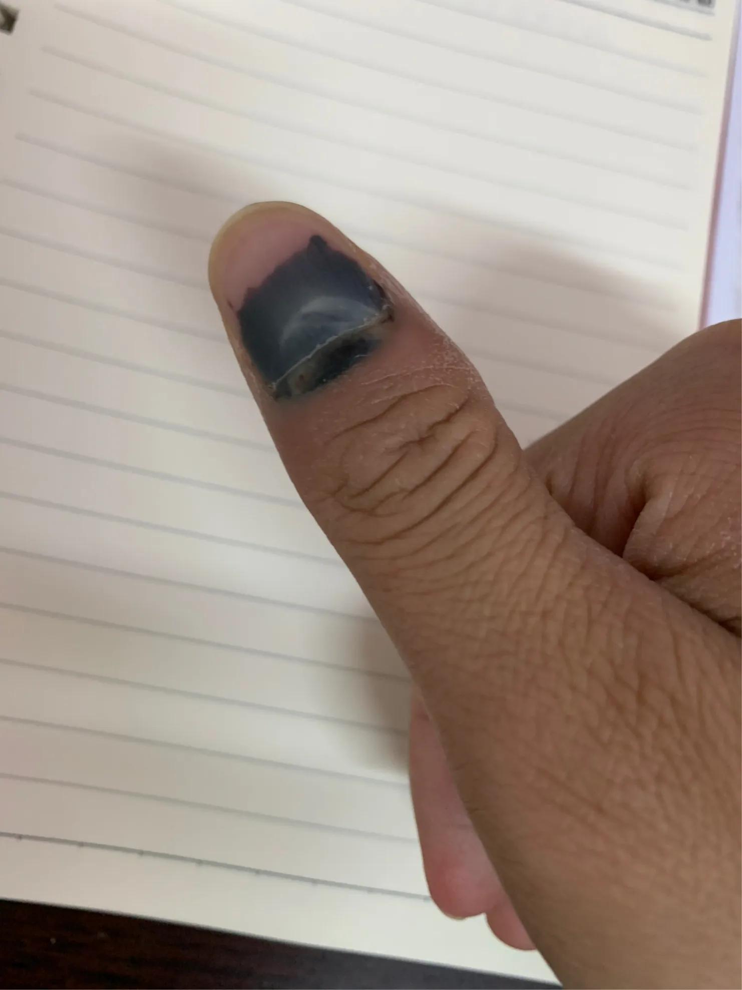 手指被夹出淤血该怎么办,手指被门夹淤血疼到睡不着