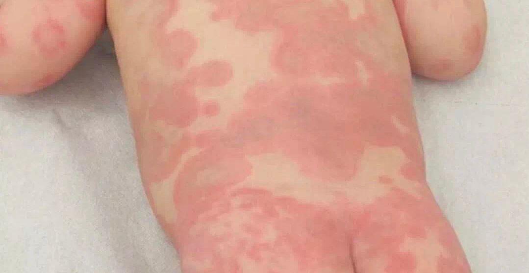 幼儿急疹出疹7天不退反而更多了,婴儿急疹高烧到40.3度不退怎么办