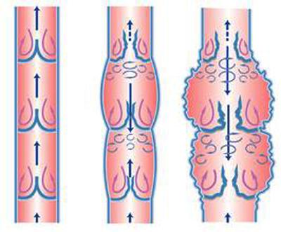 “医生，我腿上一条条青筋是怎么回事，像蜘蛛网、像蚯蚓”