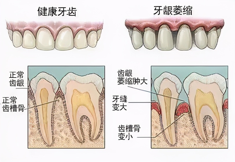 吃东西塞牙缝可以补牙缝吗,医生牙缝大怎么办