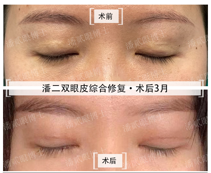 双眼皮修复具体要问什么,双眼皮修复过程中注意事项