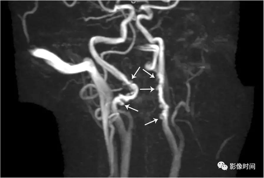 双侧颈动脉鞘间隙多发小淋巴结影,双侧颈动脉间隙多软组织密度结节