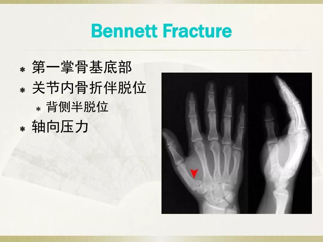 骨科x光片读片技巧,放射科骨科读片教程