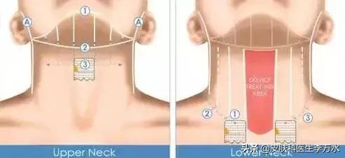 张雨绮说超声刀就像在烤肉？！线雕和超声刀，究竟哪个更靠谱？