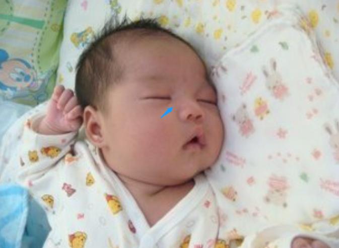 婴儿塌鼻梁怎么改善,宝宝的鼻梁
