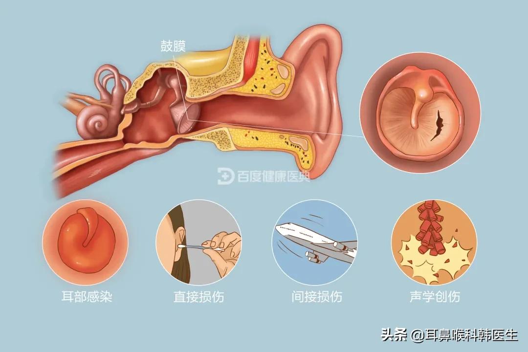 外伤鼓膜穿孔发炎怎么治,耳鼓膜穿孔怎么治