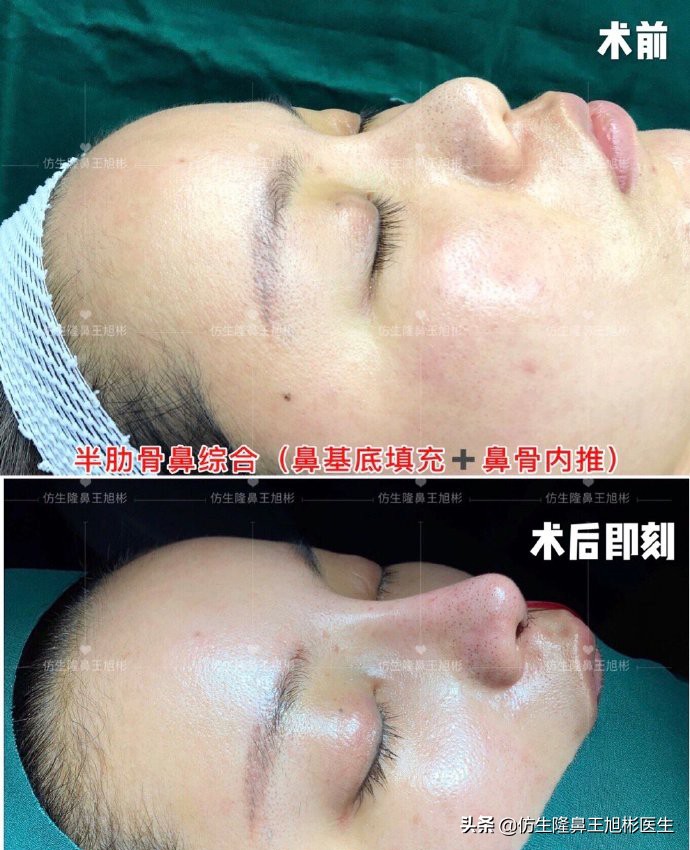 鼻头部位整形,鼻头圆钝高鼻梁整形案例