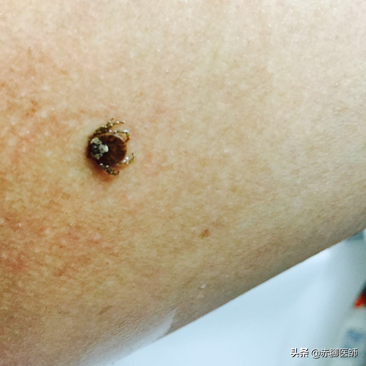 蜱虫叮咬后正确处理方法,蜱虫长期叮咬在人身上会怎样