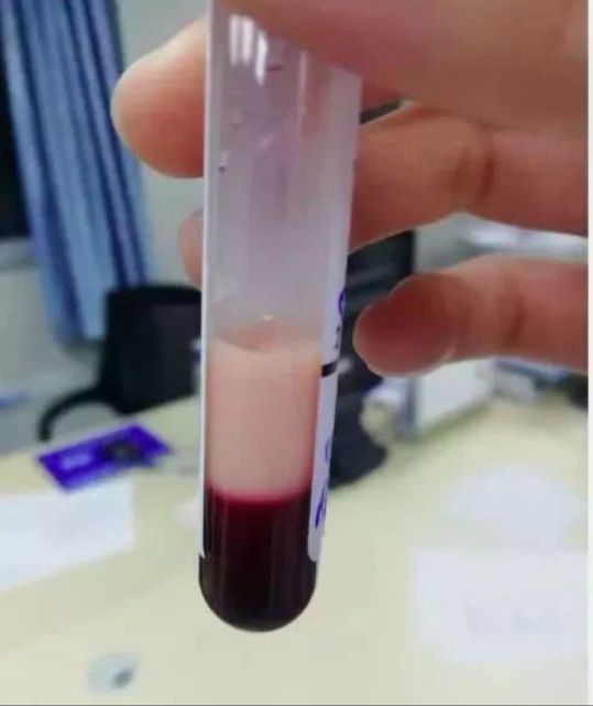 抽血发现血颜色发黑怎么回事,抽血颜色发黑是不是有毒素
