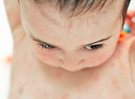 湿疹老不好到底看中医还是看西医,湿疹不一定是坏事吗
