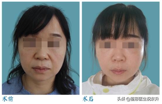 拉皮手术可以去除眼下细纹吗,拉皮手术能去除苹果肌吗