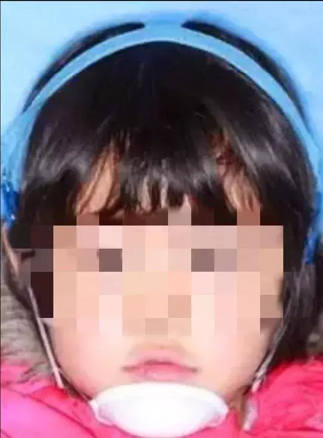 小朋友牙齿地包天矫正方法,牙齿地包天多大矫正最合适