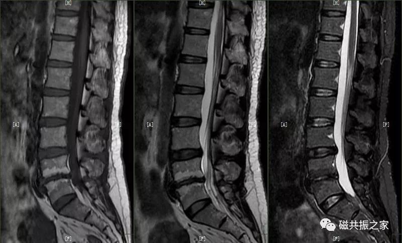 腰椎有哪些病变,腰椎病变有几种