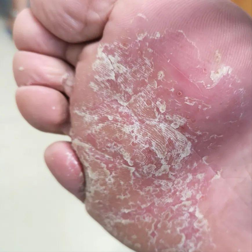 你以为的脚气还不是脚气