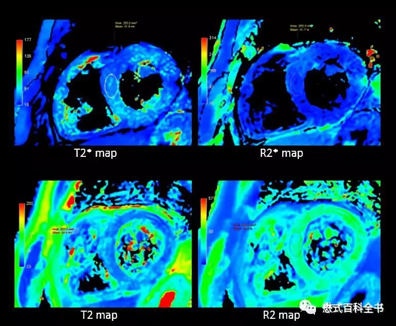 心脏磁共振定位方法,心脏磁共振各参数分析