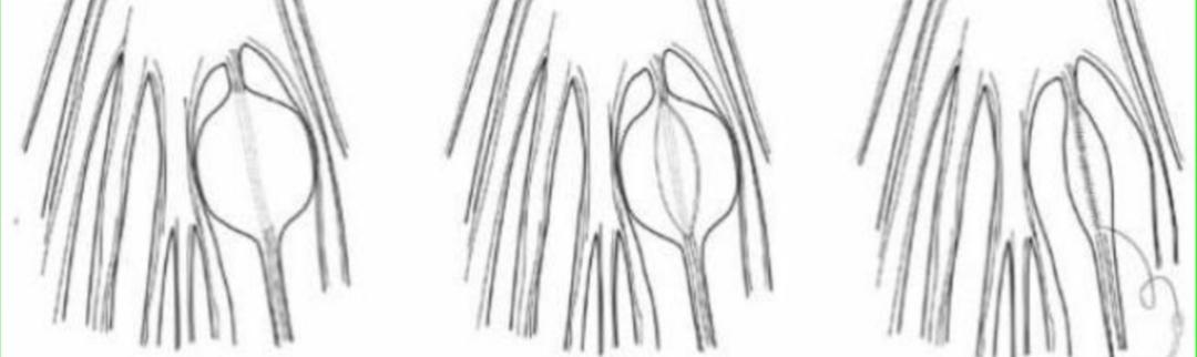 骶管囊肿介入治疗最新进展,骶管囊肿可以鉴定出来吗