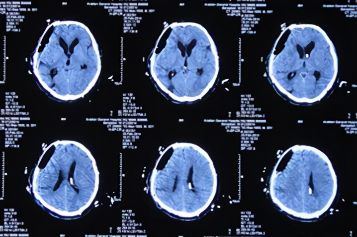 脑外伤开颅手术后脑积水,脑外伤手术后脑脊液鼻漏怎么治疗