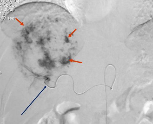可视不盲目、微创保安全、患方可参与。介入诊疗模式方兴未艾!