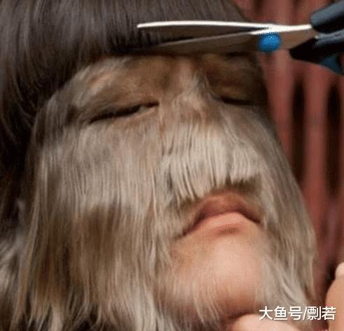 女孩突发怪病脸部疯狂生长,女孩患病满脸毛发