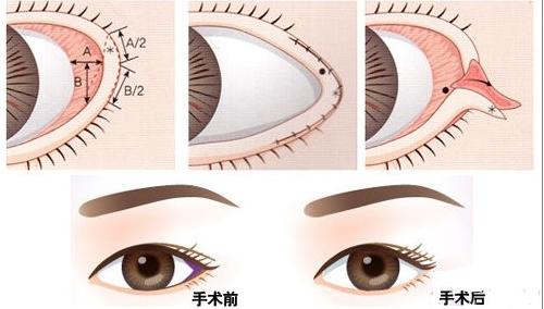 做开外眼角,想做眼睛手术不能做怎么办