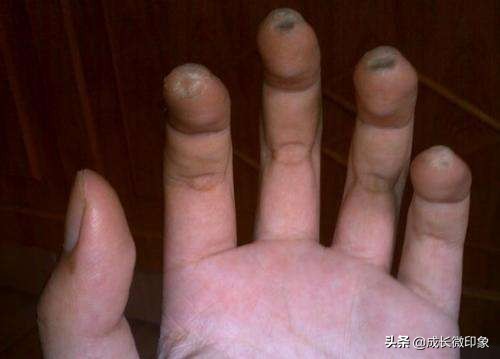 手疼弹吉他,弹吉他手指疼怎么办如何缓解