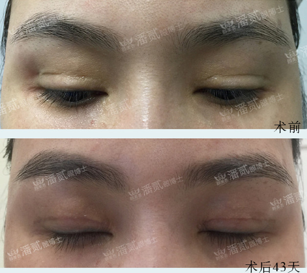 双眼皮修复有失败的吗,双眼皮修复失败了会怎样