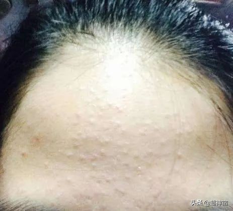 比痘痘更烦人的闭口来了,最有效的去闭口*法大**看过来