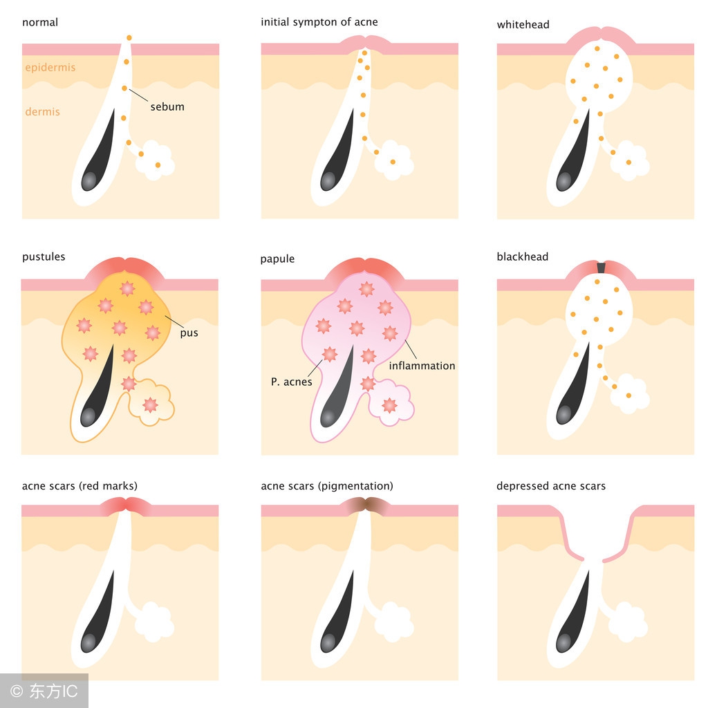 痘痘挤出的是黑色的东西,痘痘里挤出来的白色的痘痘怎么办