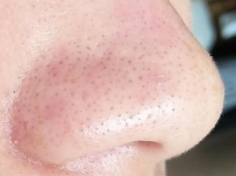 小苏打去黑头小窍门简便又有效,去黑头小妙招小苏打粉