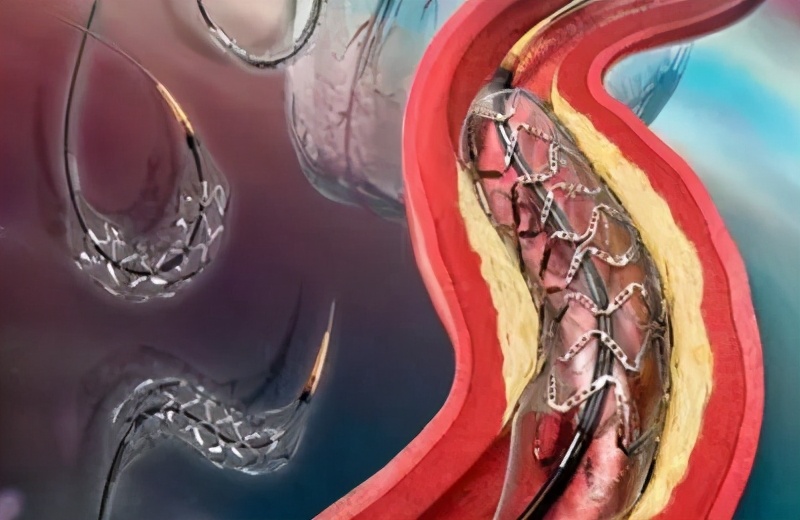 心脏支架了以后还要搭桥吗,心脏支架装好还会出现脑梗吗