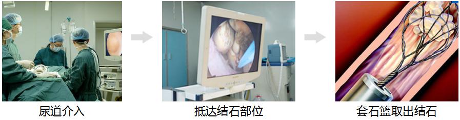 体外碎石治肾结石,结石体外碎石手术有效果吗