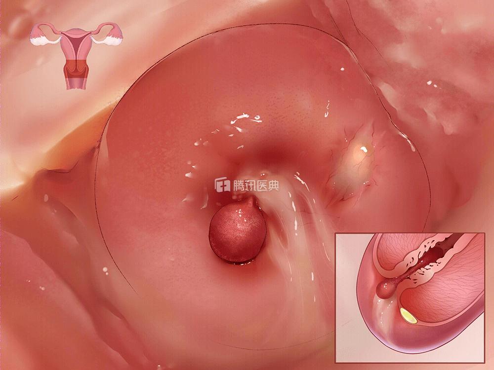 妇科炎症反复发作，医生却让丈夫来检查……