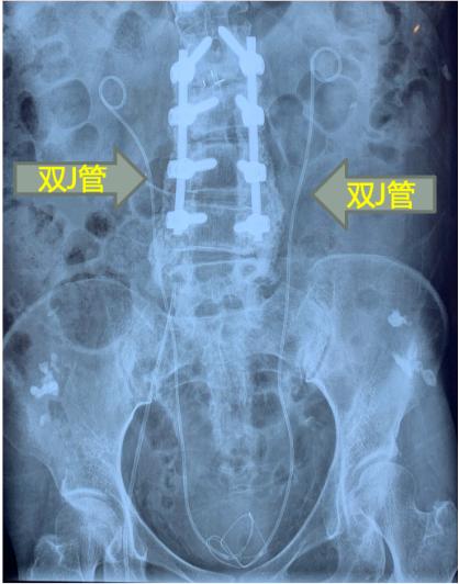 老年人肾结石感染最严重吗,肾结石微创真菌感染怎么办