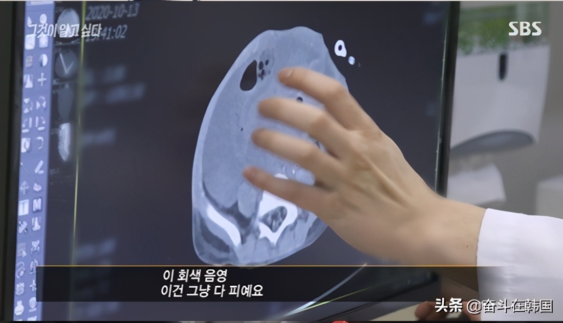 男童被虐待肝破裂,韩国小孩被家暴内脏破裂
