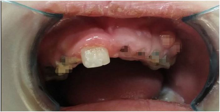 孩子的乳牙要掉了可以拔吗,小孩的乳牙真的可以治疾病吗