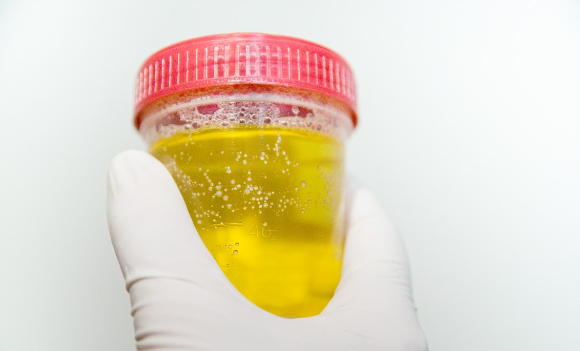 少尿无尿多尿的判断标准是什么,多尿和少尿哪个正常