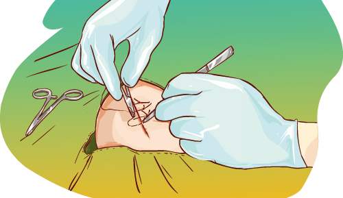 关节置换术后周围胀怎么办,关节置换后一直流水怎么办