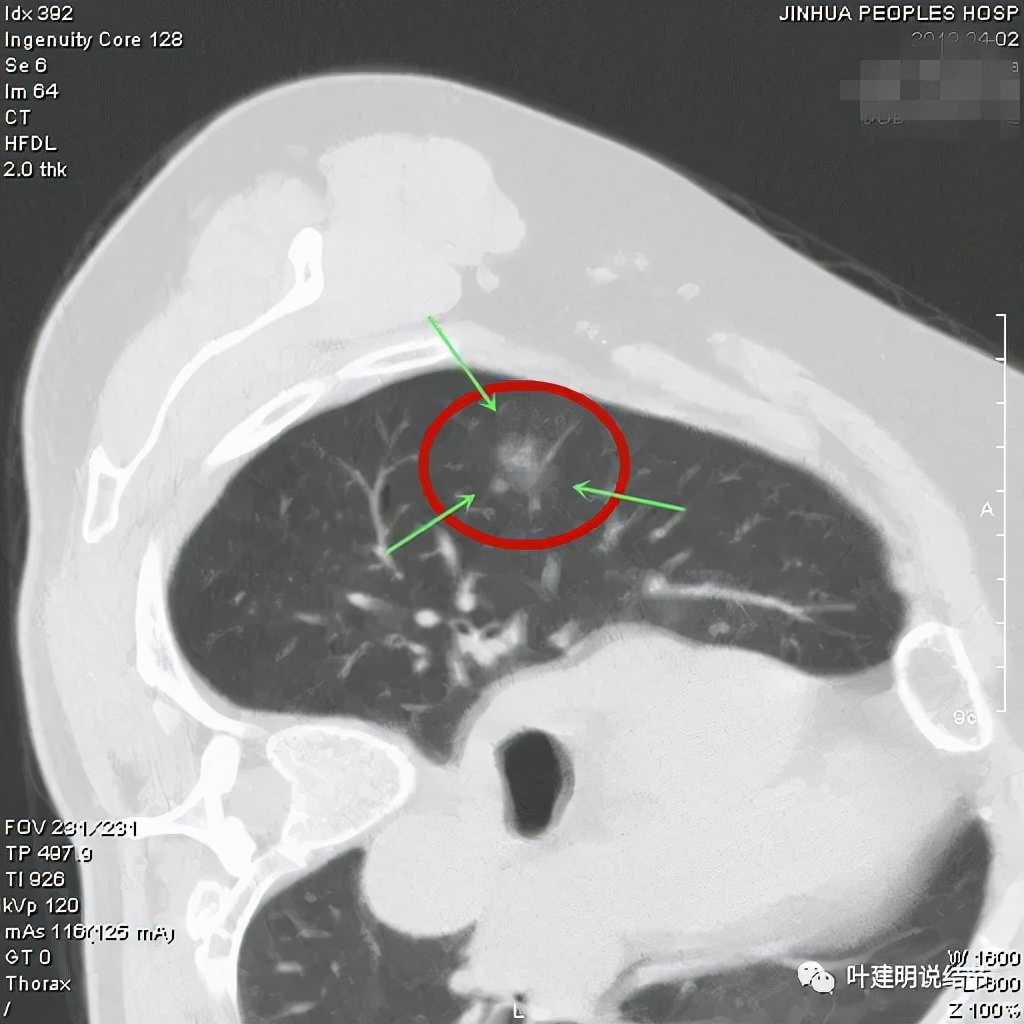 怎样从病理报告看是不是原位癌,原位腺癌切除子宫要开刀吗