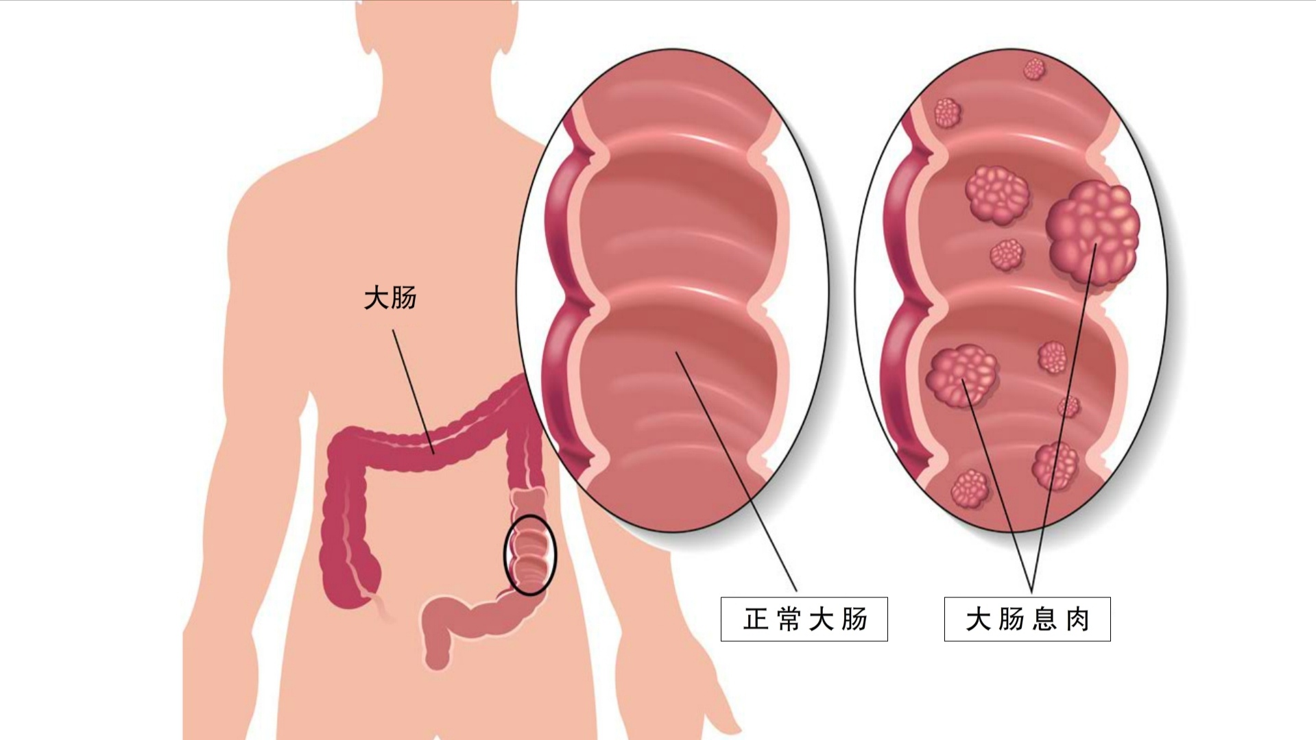 吃什么中药可以预防肠息肉复发,运动可以预防肠息肉复发吗