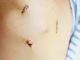 心脏瓣膜手术微创开胸,瓣膜病手术开胸