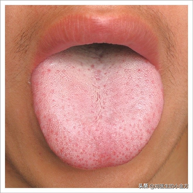 中医舌诊对照表100例,舌诊辨九大体质