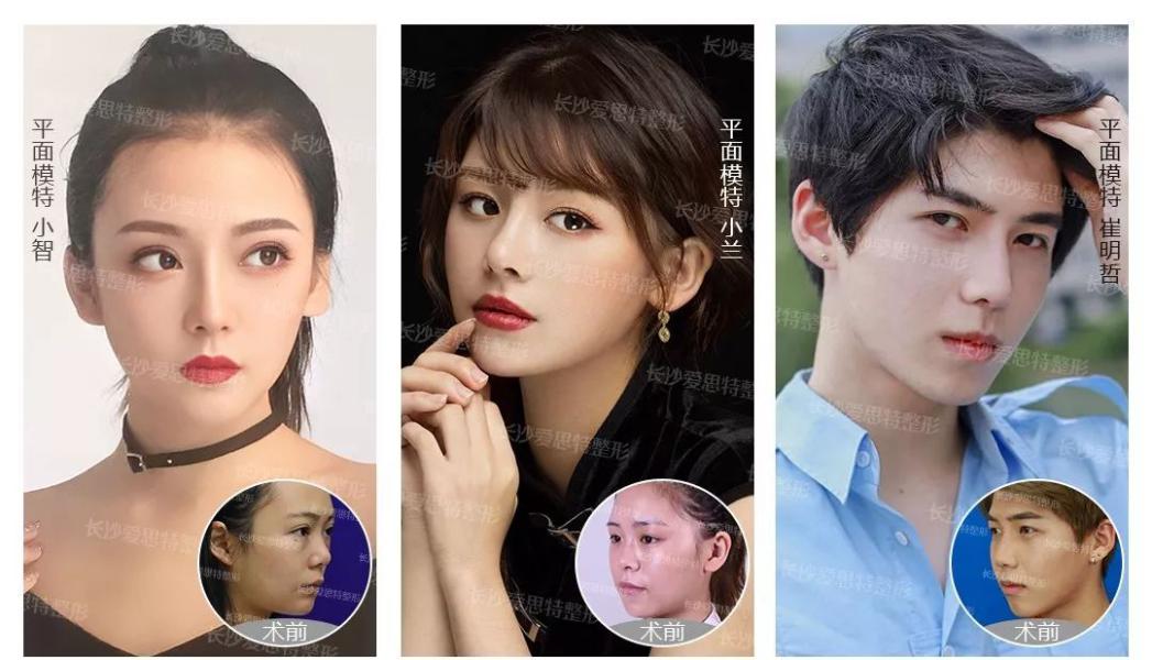 隆鼻整形手术前注意事项,隆鼻术后吃什么可以快速恢复