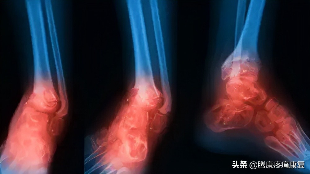 小腿膝关节疼痛是什么原因,小腿窝疼痛是什么原因造成的