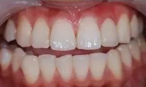 二氧化锆牙齿能做ct和核磁共振吗,氧化锆全锆牙冠能做核磁共振吗