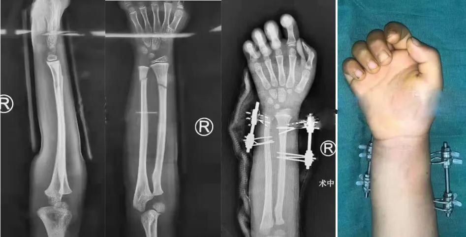 两个儿童前臂骨折争议病例之——元芳你怎么看