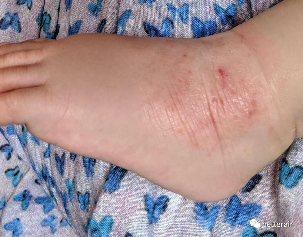 宝宝湿疹咳嗽流涕减轻,宝宝湿疹反复奇痒难忍