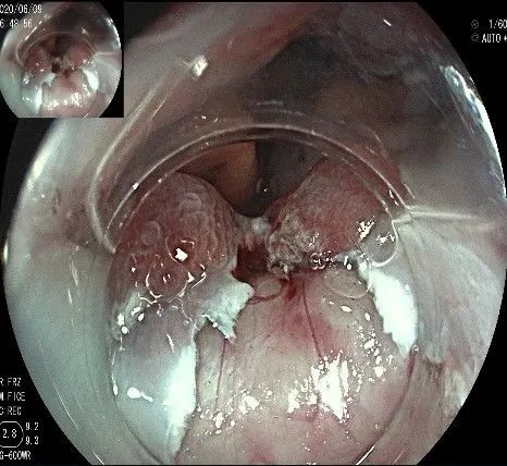 贲门处见隆起性病变,贲门高级别瘤变esd术后不能吃什么