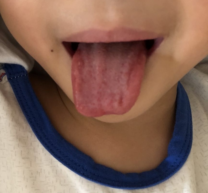 小孩如何通过舌象判断感冒,胃病反反复复看舌象