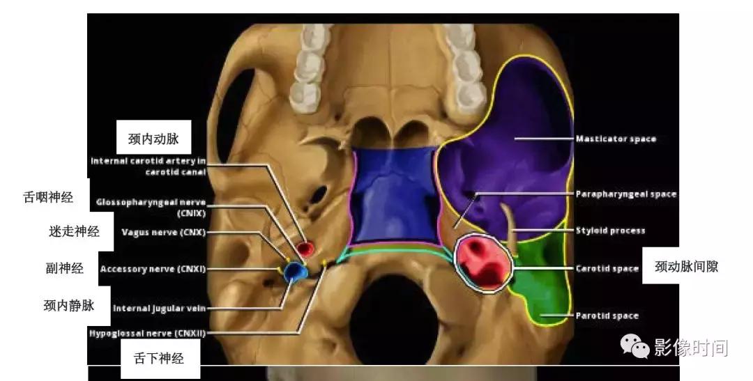 双侧颈动脉鞘间隙多发小淋巴结影,双侧颈动脉间隙多软组织密度结节